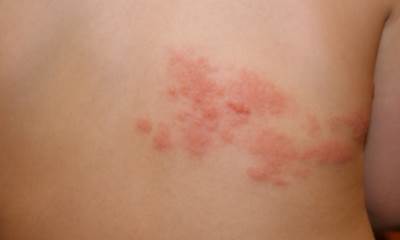 Опоясовый герпес