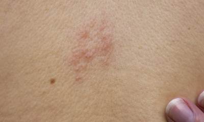 Симптомы герпеса на спине