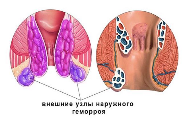Внешний геморрой