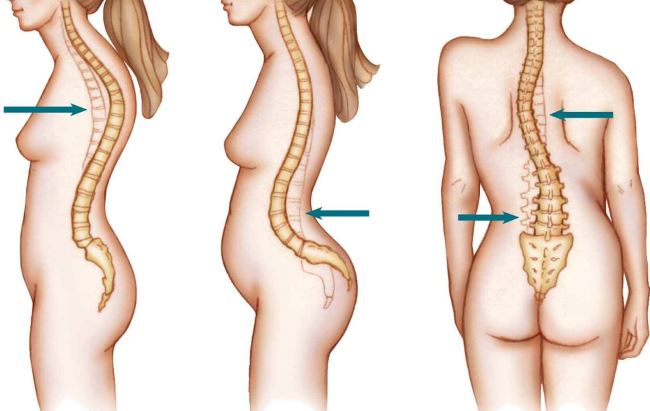 Искривление позвоночника в поясничном отделе