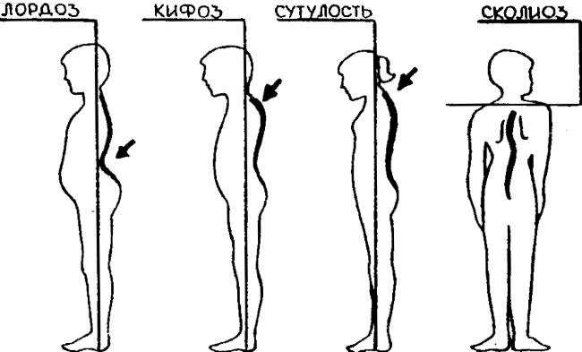 Искривление позвоночника у детей