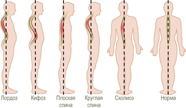 Искривление позвоночника
