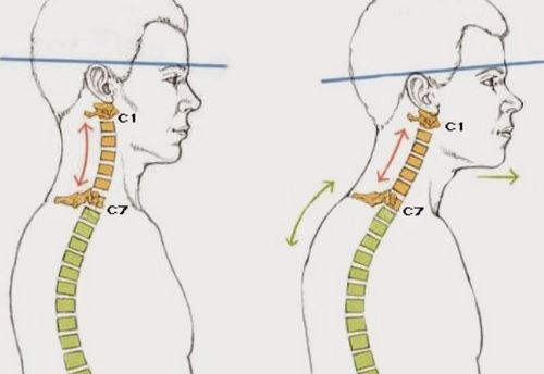 Искривление шейного отдела позвоночника
