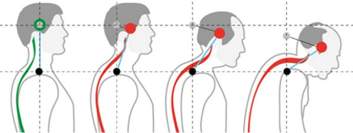 Кифоз шейного отдела позвоночника