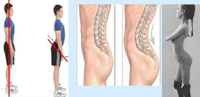 Лордоз поясничного отдела