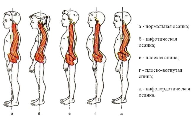 Нарушение осанки у детей
