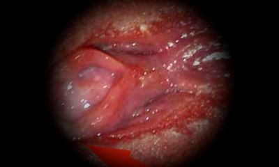 Воспаление уретры у женщин