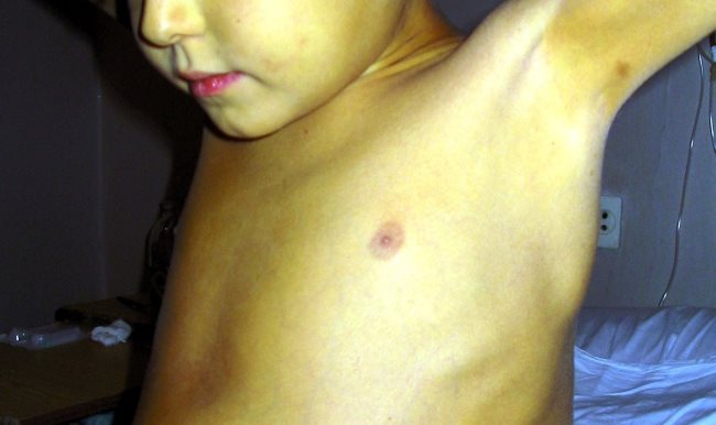 Ребенок болеющий желтухой