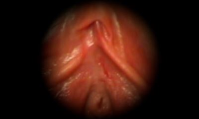 Уретрит у женщин