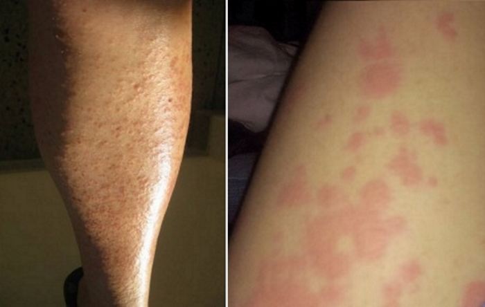 Aллергия на мороз на ногах