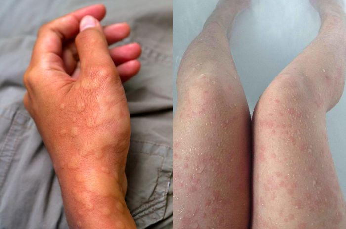 Aллергия на холод на коже