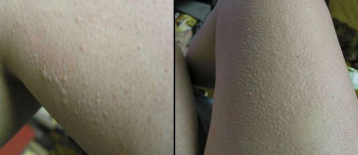 Аллергия на холод на ногах