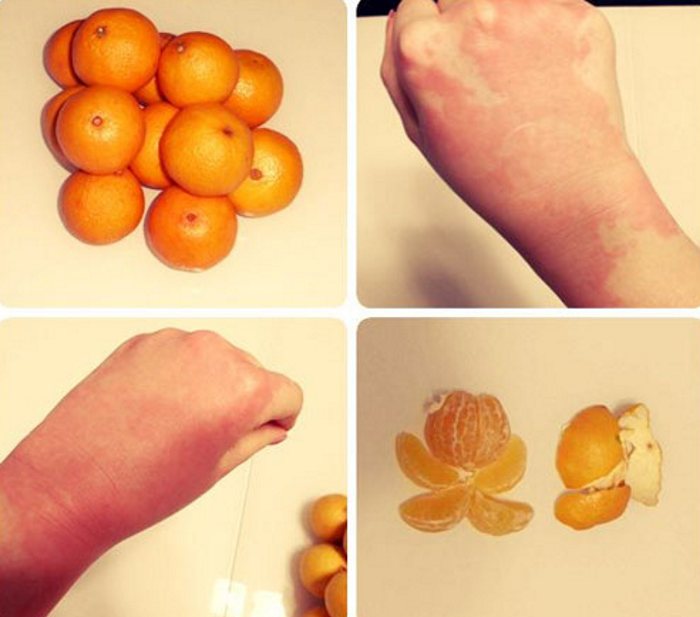 Аллергия на мандарины