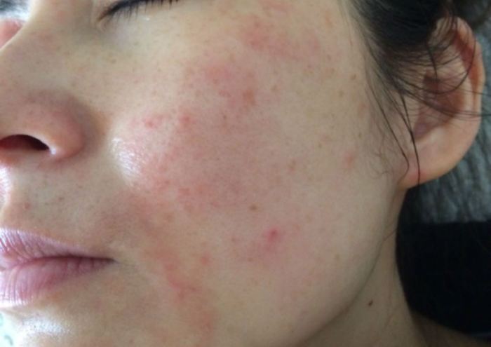 Аллергия на мороз на лице