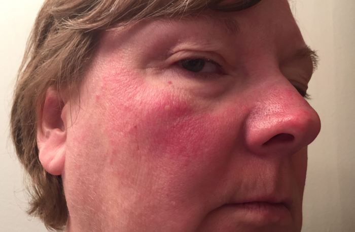 Симптомы аллергии на водку