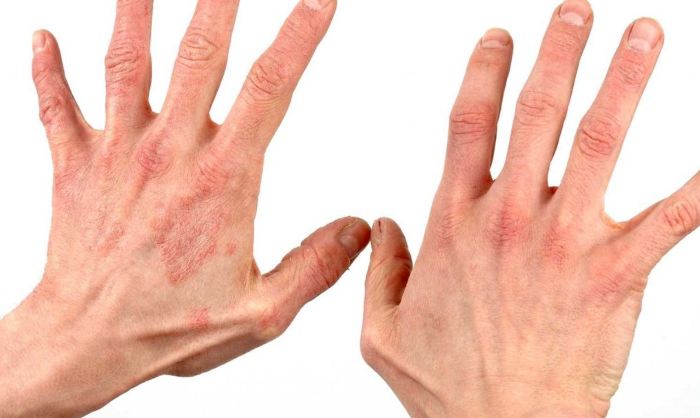 Симптомы аллергии на холод у взрослых