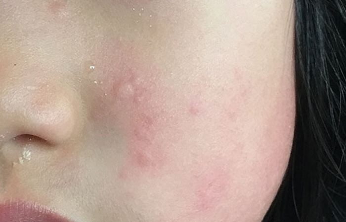 Холодовая аллергия