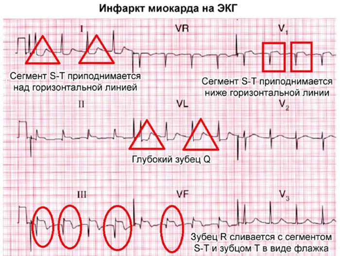 ЭКГ при инфаркте миокарда