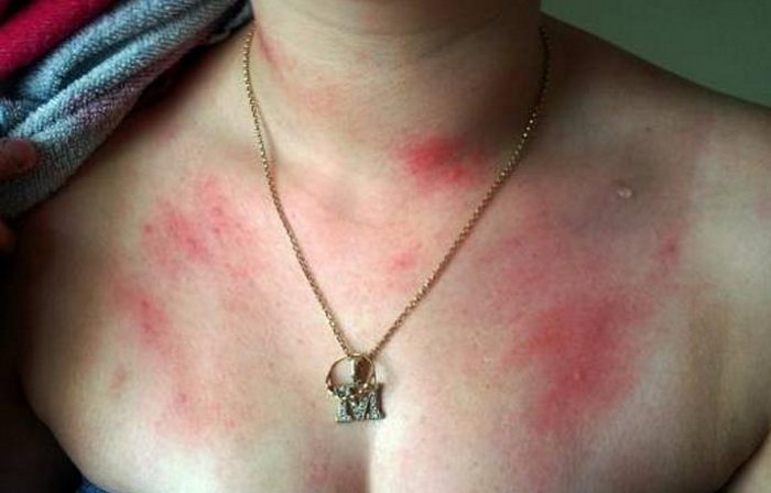 Аллергия на воду