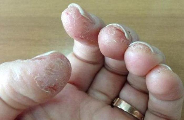 Aллергия на гель лак