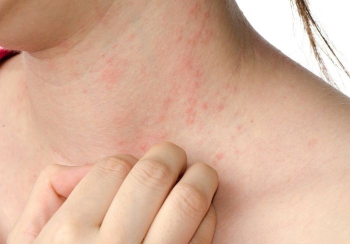 Аллергия на кофе