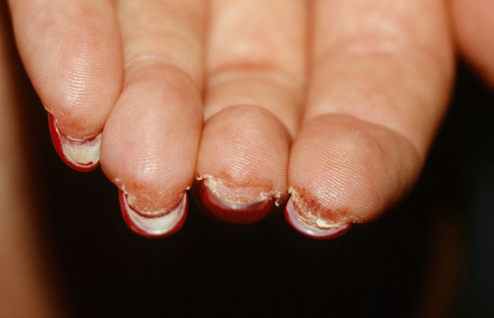 Aллергия на шеллак