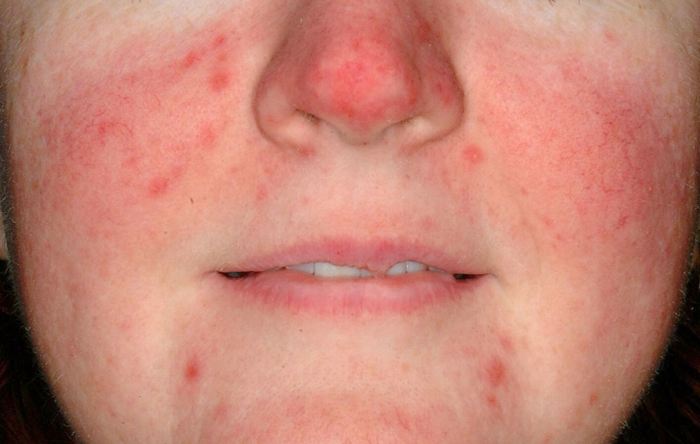 Аллергия на витамины