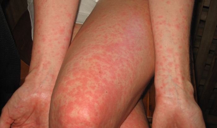 Аллергия на сладкое у взрослых