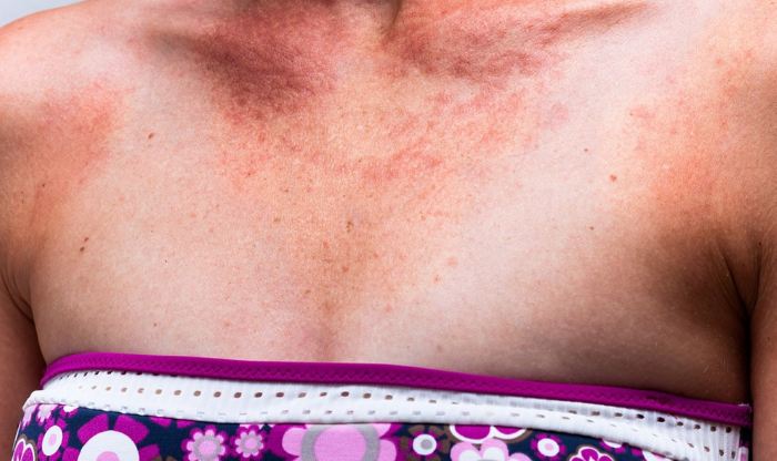 Аллергия на солнце