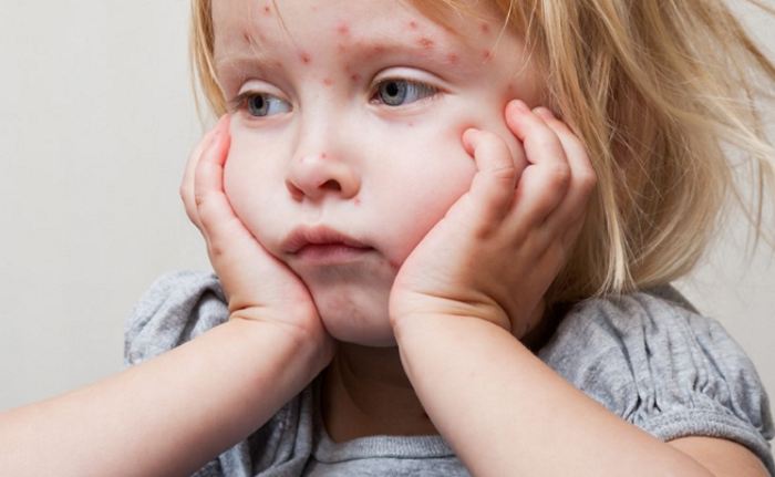 Пищевая аллергия у детей