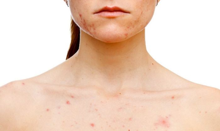 Пищевая аллергия