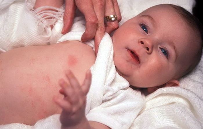 Аллергия на коровий белок