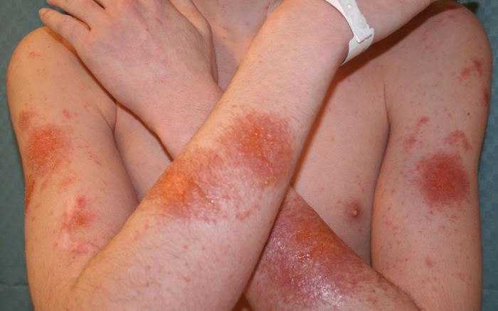 Аллергия на креветки