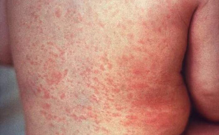 Аллергия на курицу