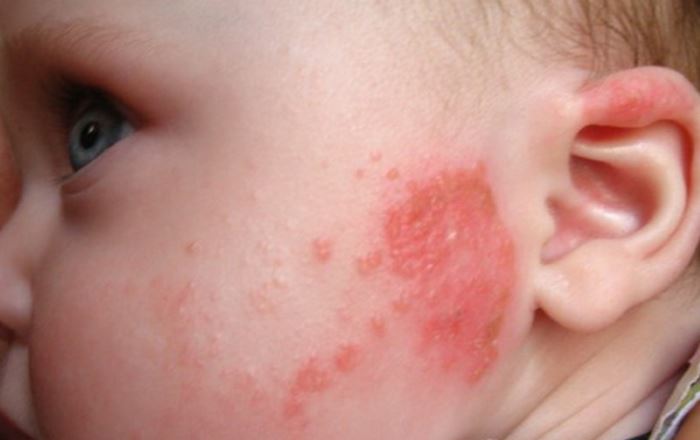 Аллергия на рыбу