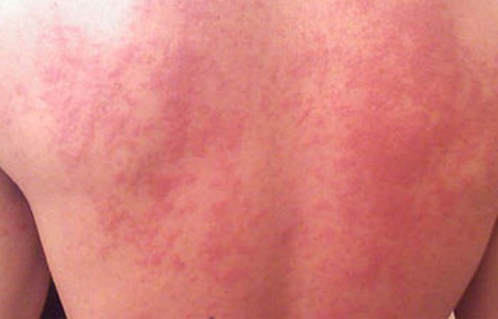 Аллергия на солярий