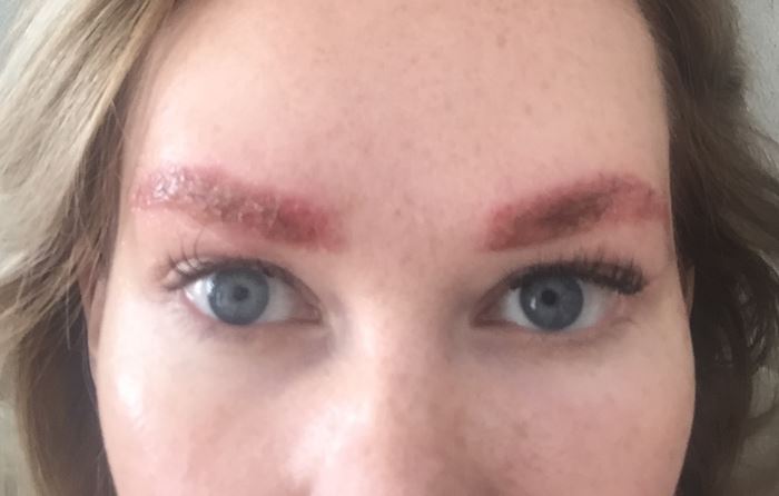Аллергия на татуаж бровей
