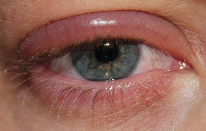 Аллергия на тушь для ресниц
