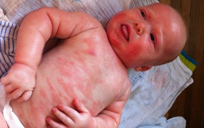 Аллергия на яйца