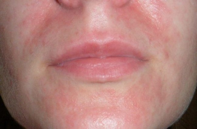 Симптомы аллергии на имбирь