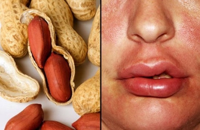 Аллергия на арахис