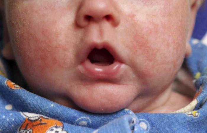 Аллергия на кукурузную кашу