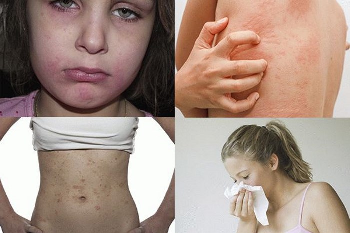 Аллергия на орехи