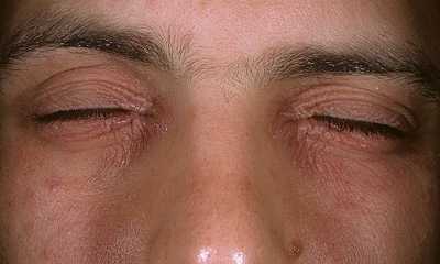 Аллергический дерматит