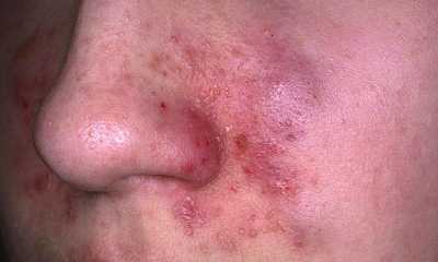 Атопический дерматит