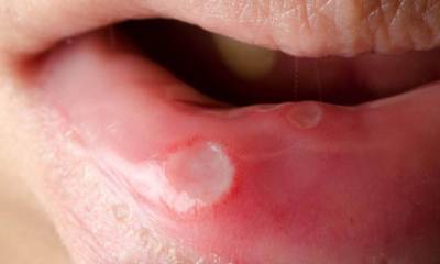 Афтозный стоматит