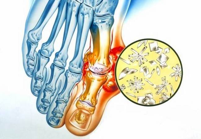 Болезнь подагра