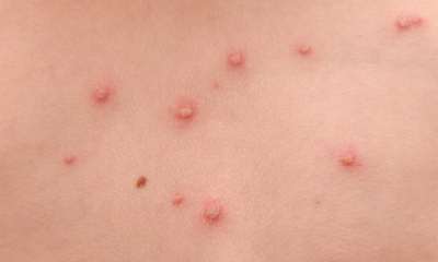 Ветрянка в легкой форме