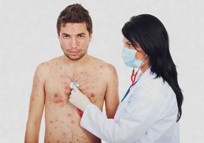 Ветрянка у взрослых