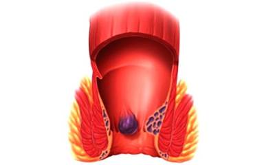 Внутренний геморрой